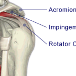 impingement